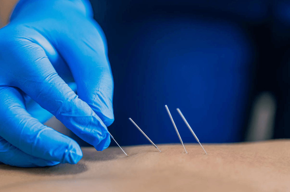 A person's upper back and shoulder with blue kinesiology tape applied for support or pain relief, with a hand resting on the taped shoulder.